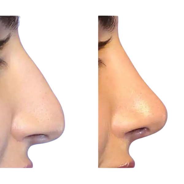 closed nose job