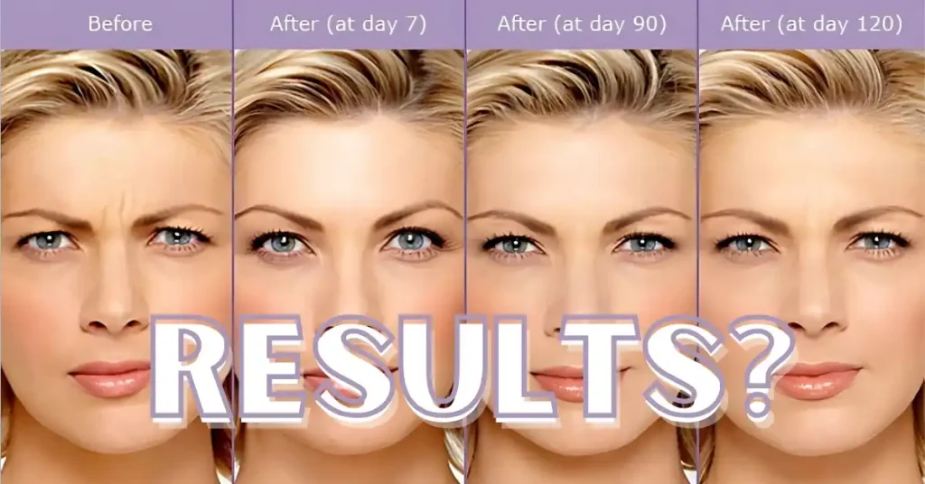 botox in costa mesa