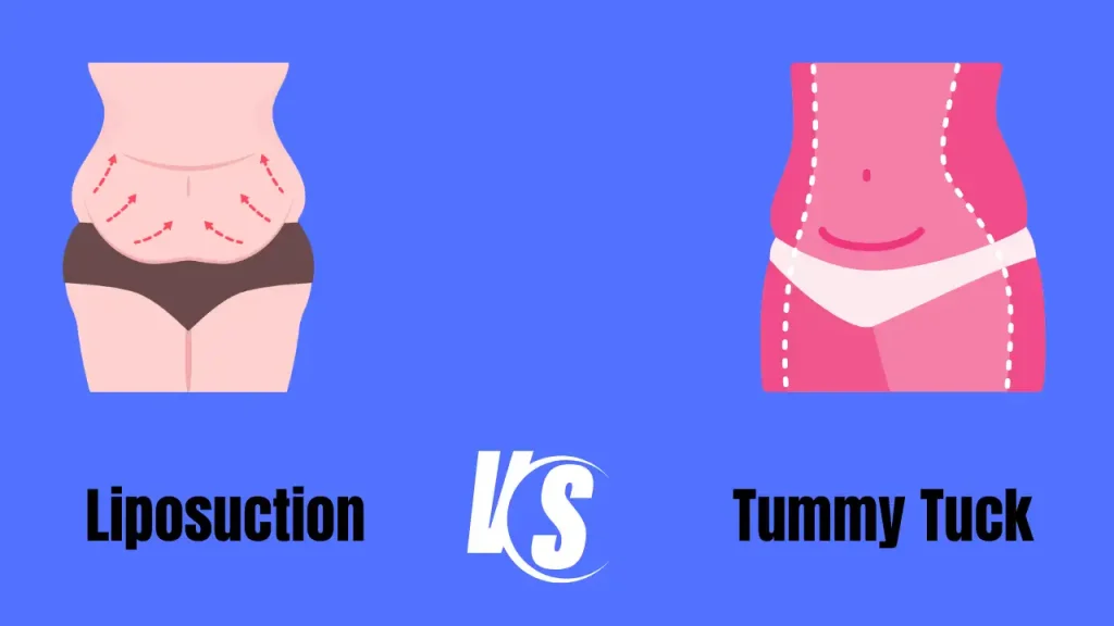 liposuction