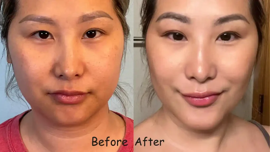 Liposuction Chicago Before and After