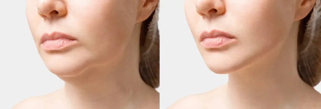 neck lipo nyc