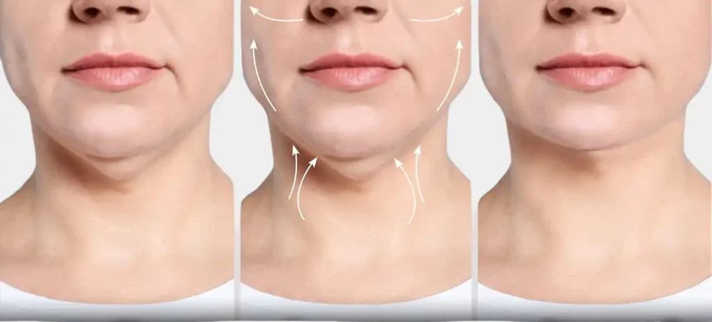 neck lipo nyc