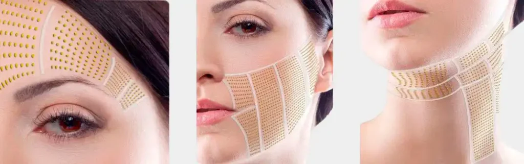 smas facelift before and after