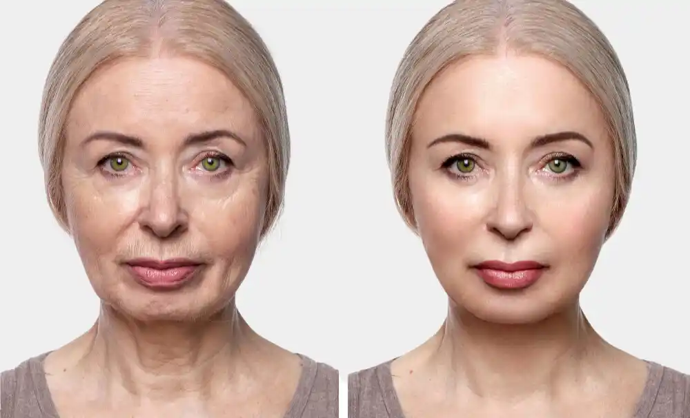 smas facelift before and after
