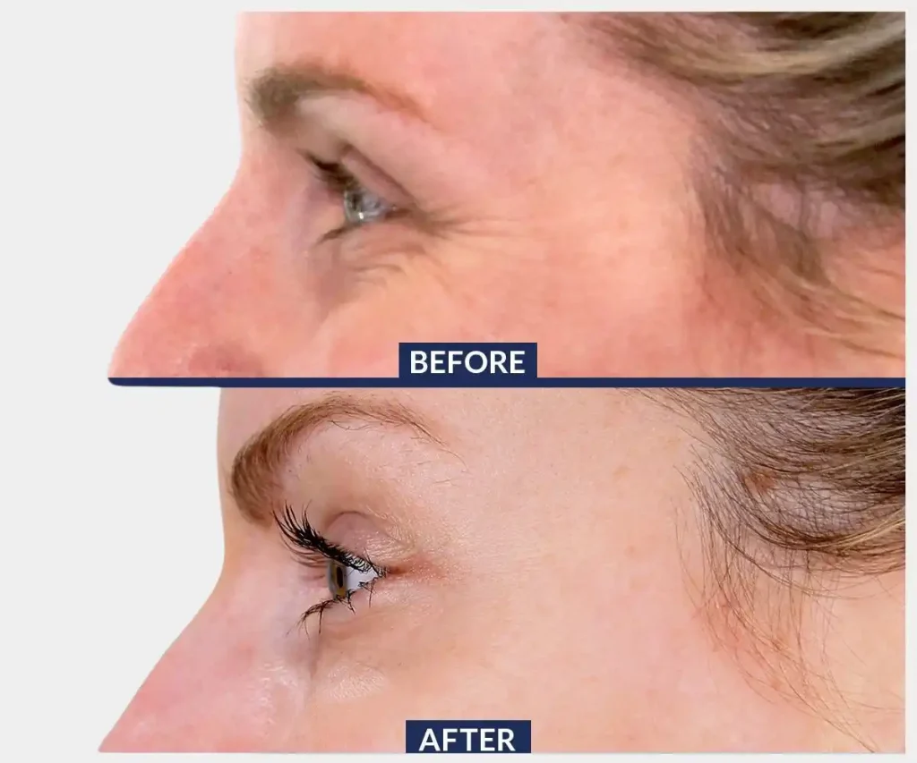 best botox in costa mesa