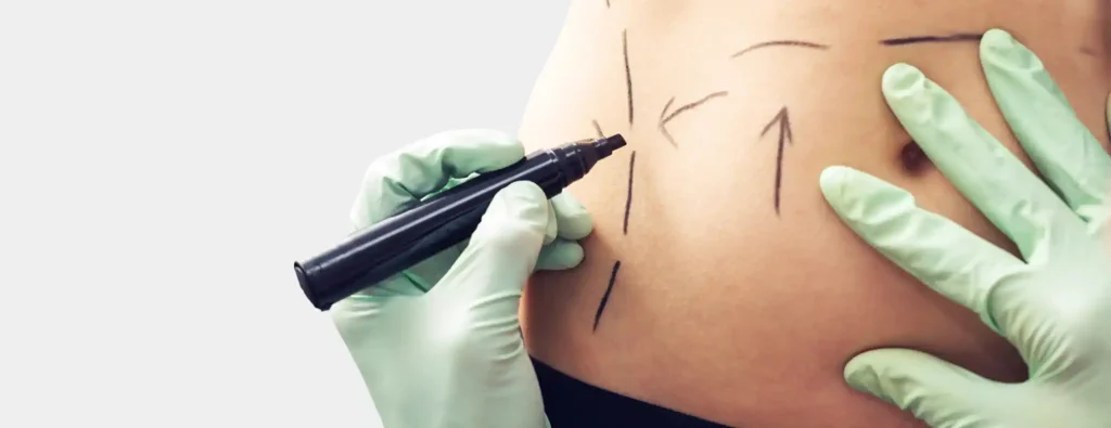liposuction nyc