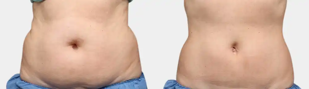 liposuction nyc