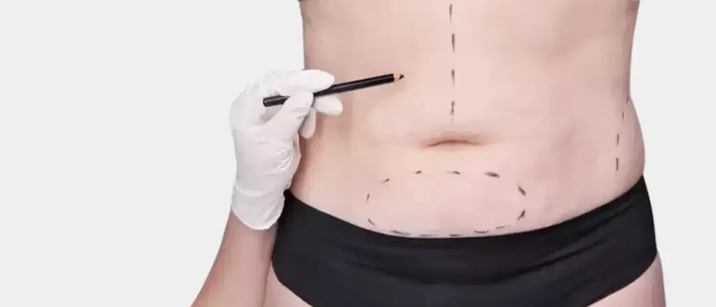 liposuction nyc