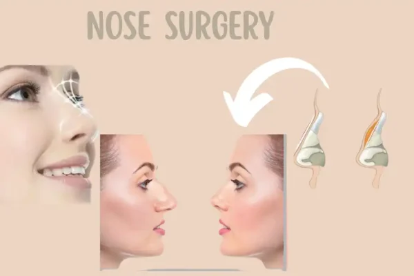 Nose Surgery in Chicago: Your Comprehensive Guide to Rhinoplasty Nose Surgery in Chicago: Your Comprehensive Guide to Rhinoplasty