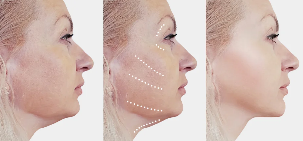 smas facelift before and after