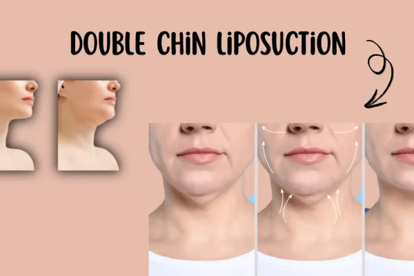 Double Chin Liposuction in Chicago | Slim Your Jawline Double Chin Liposuction in Chicago | Slim Your Jawline